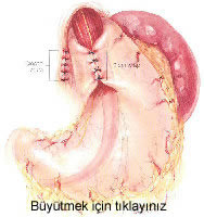 Nissen fundoplikasyonu Nissen fundoplikasyonu